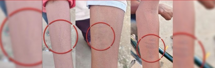 35 छात्रों ने काटी अपनी कलाई