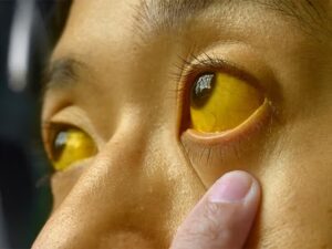 Bhilai Jaundice Outbreak